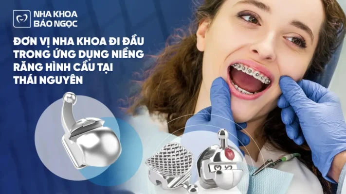 Đơn vị Nha khoa đi đầu trong ứng dụng niềng răng mắc cài hình cầu tại Thái Nguyên
