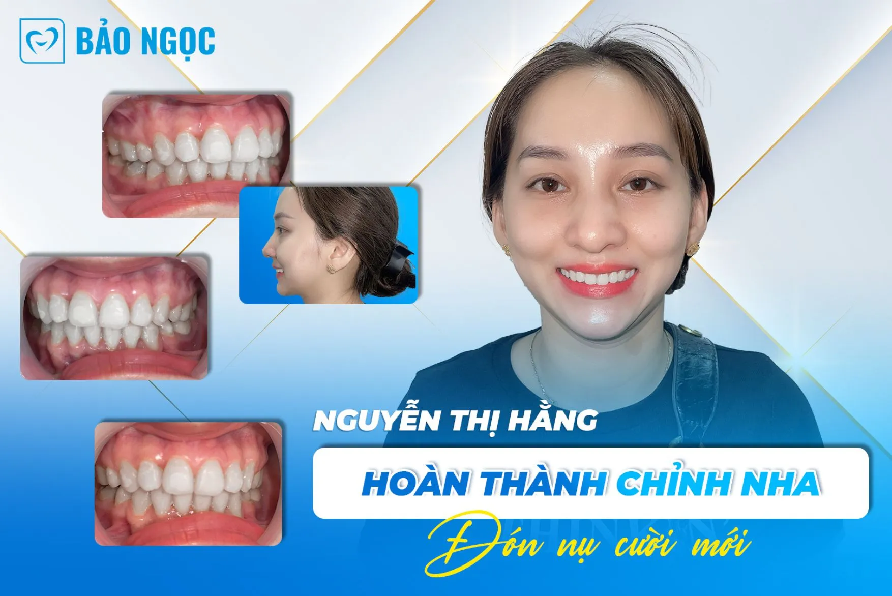 Lột xác trên gương mặt chị Hằng tháo niềng răng kết quả mong đợi