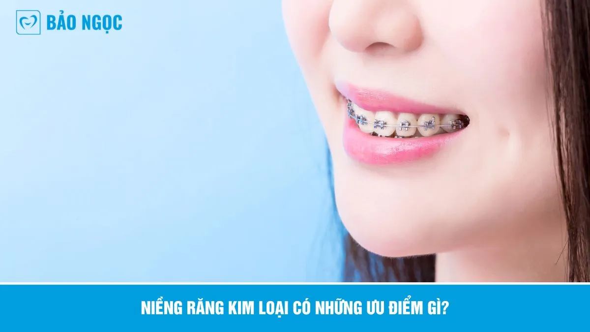 Niềng răng kim loại 