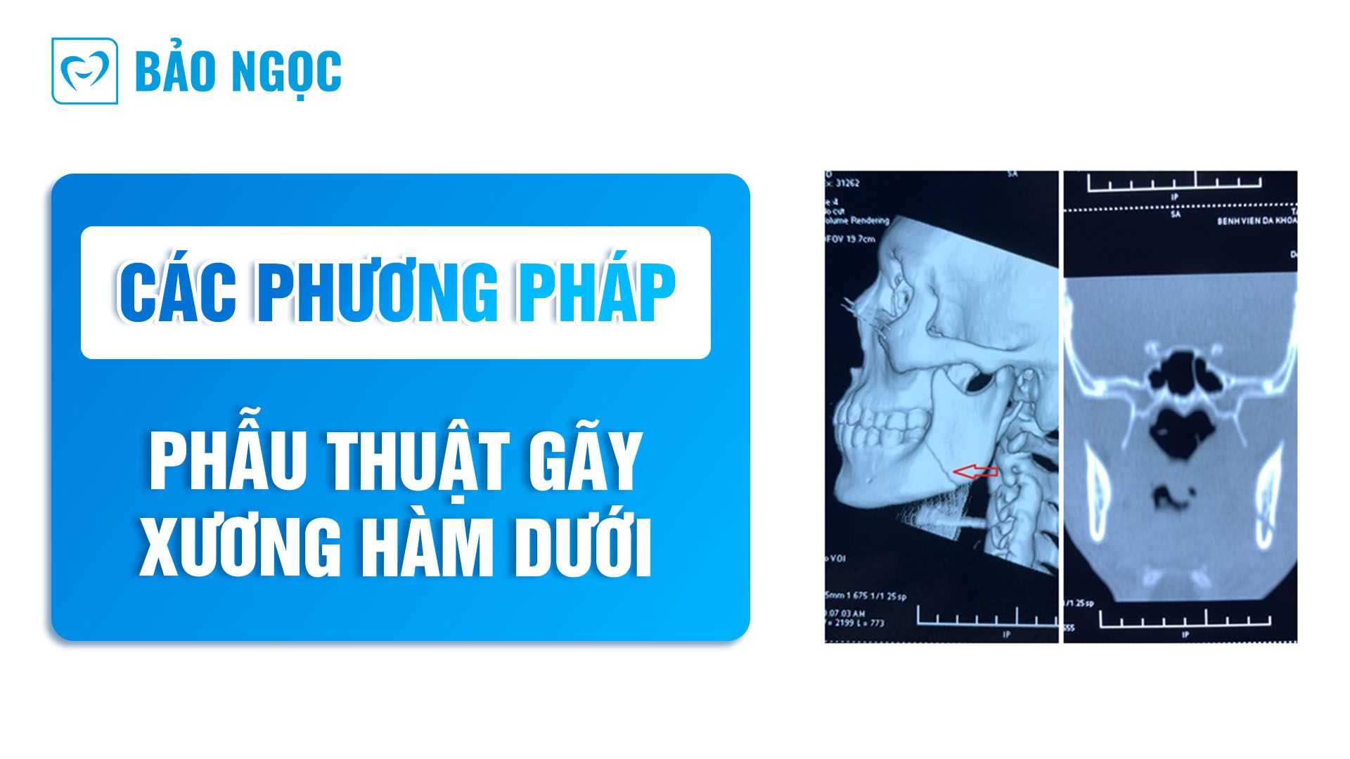 phẫu thuật gãy xương hàm dưới