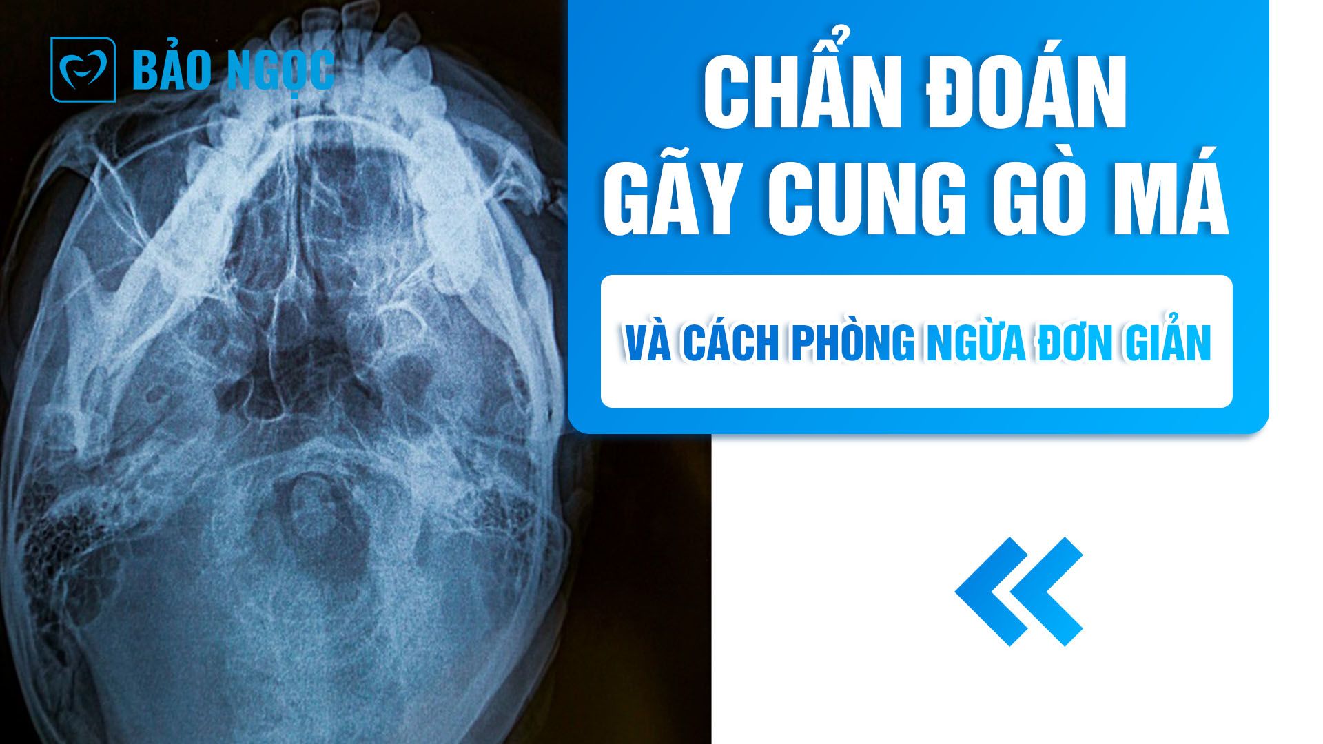 Chẩn đoán gãy cung gò má