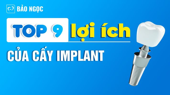 lợi ích của cấy Implant