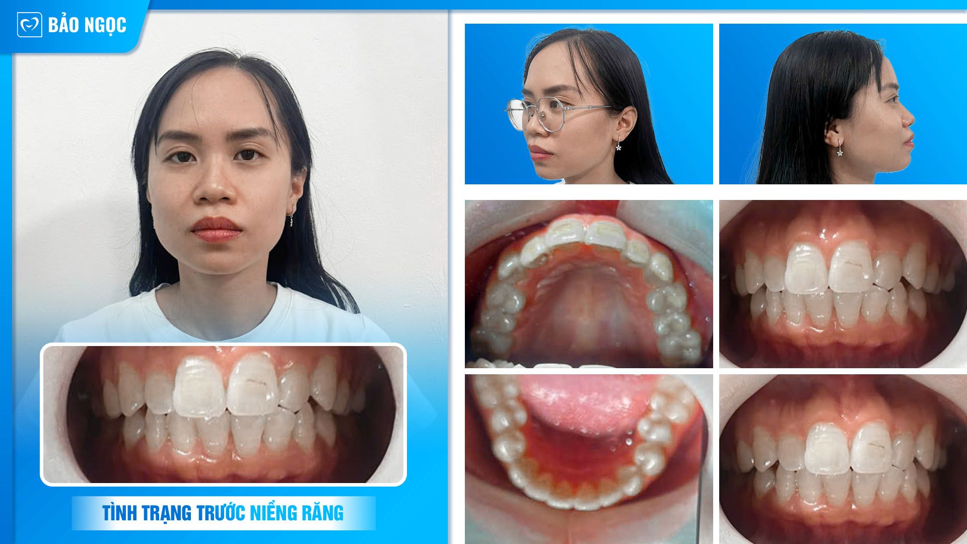 thẩm mỹ Invisalign cho chị Minh Hằng