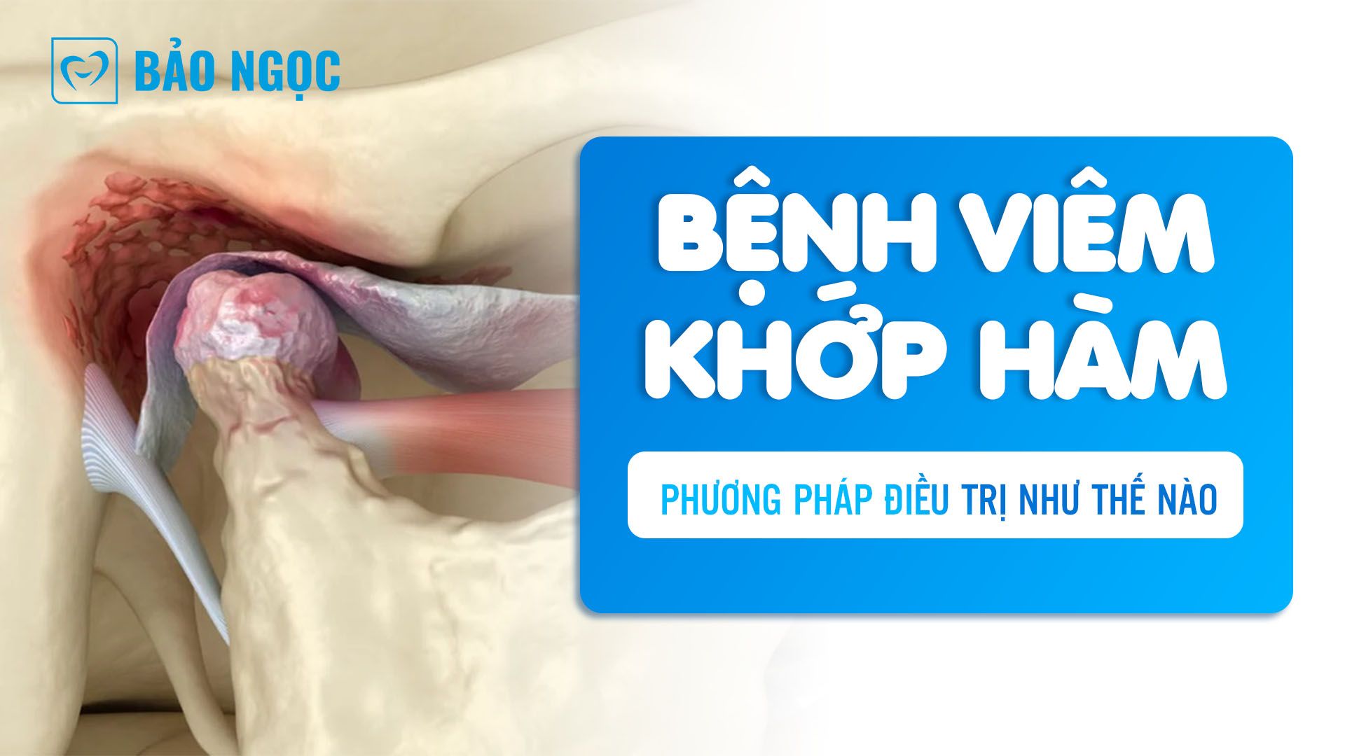 bệnh viêm khớp hàm