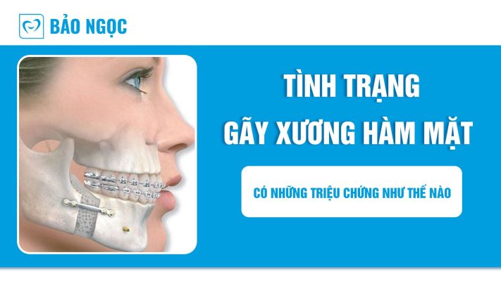 gãy xương hàm mặt