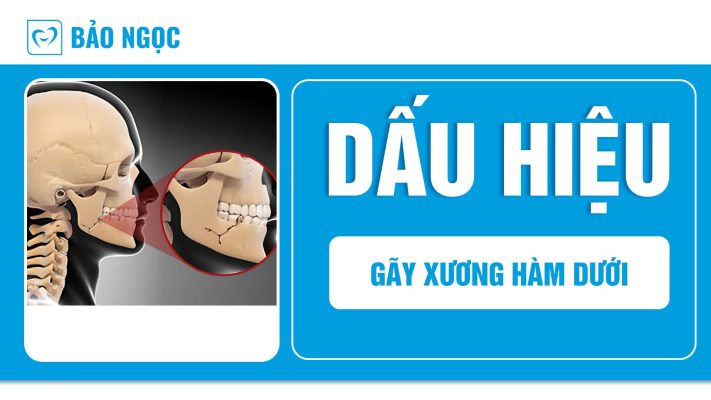 gãy xương hàm dưới