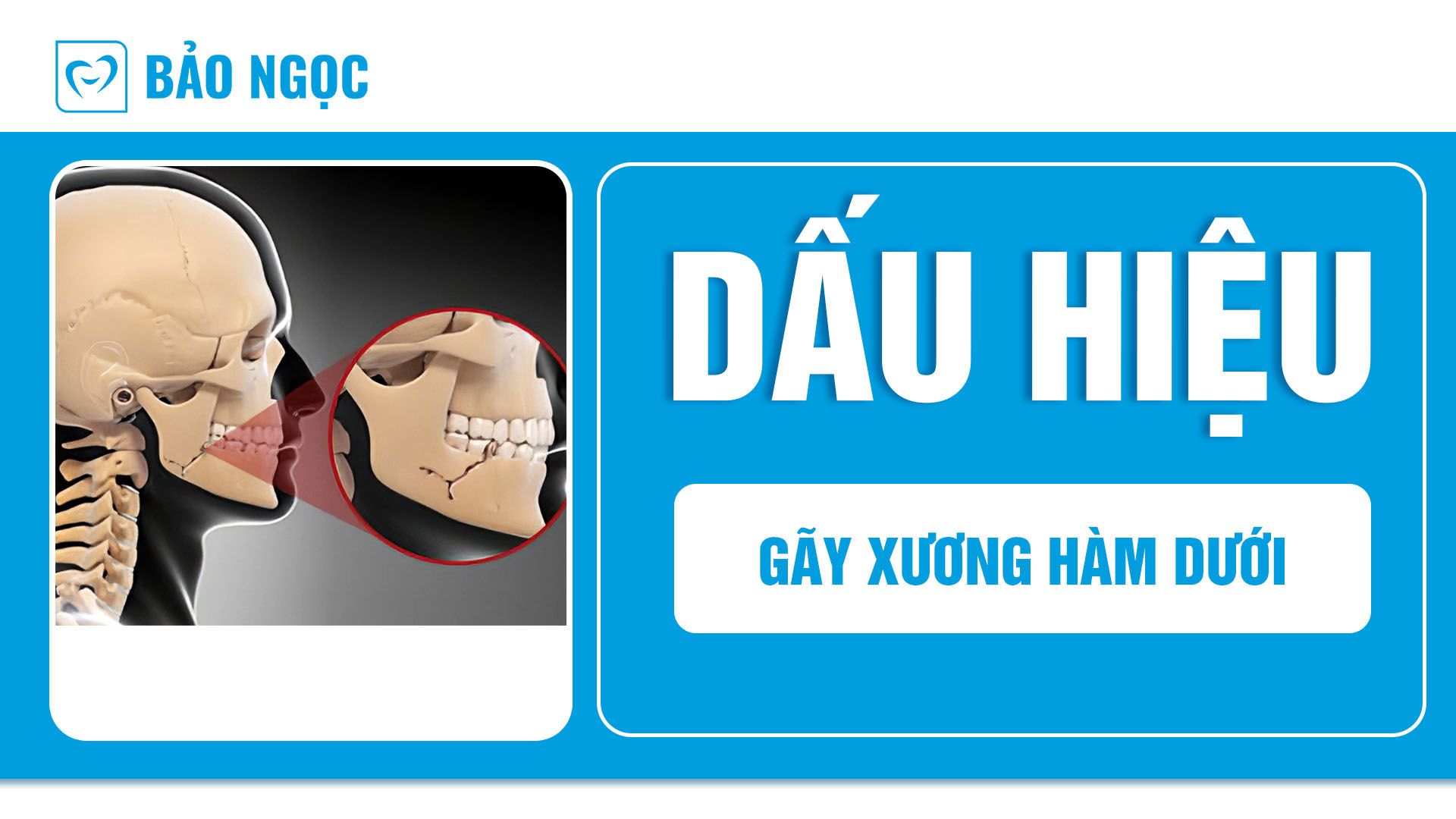 gãy xương hàm dưới
