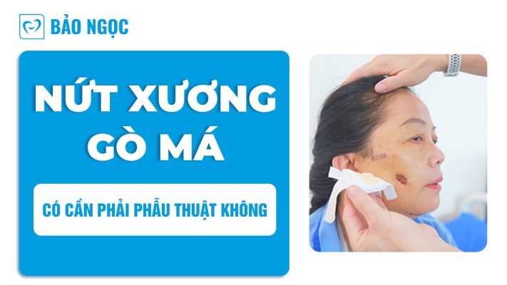 Nứt xương gò má