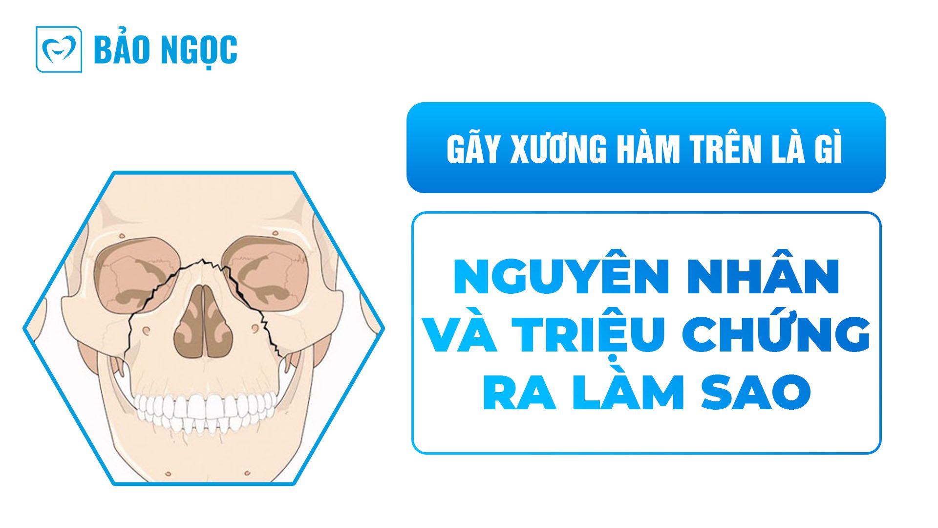 Gãy xương hàm trên