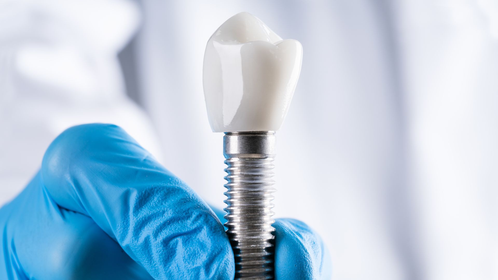  phương pháp cấy ghép Implant 