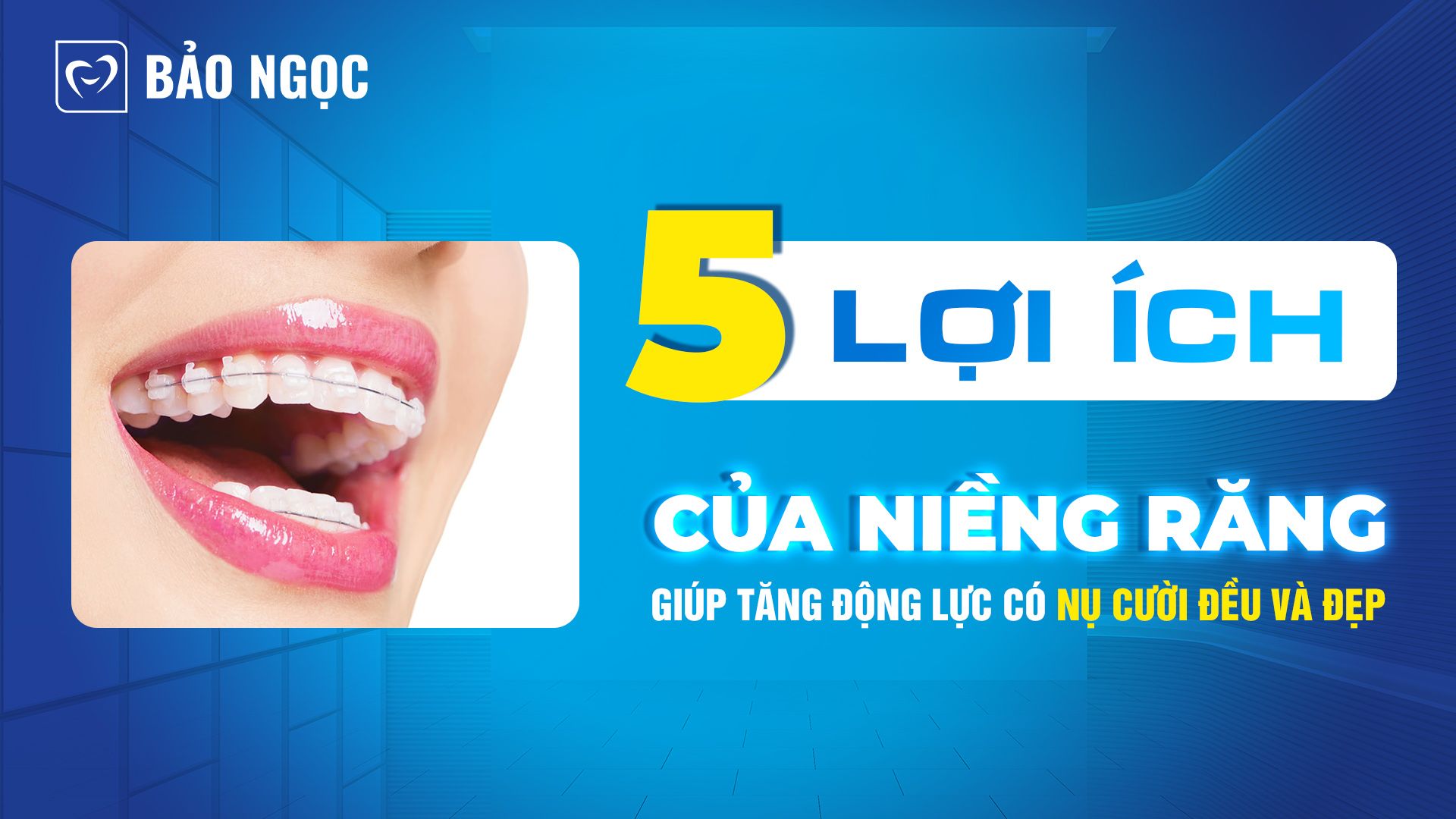 Lợi ích của niềng răng