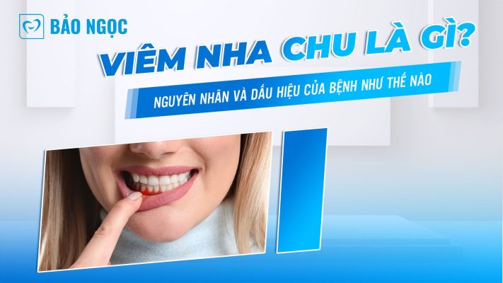 Viêm nha chu là gì?