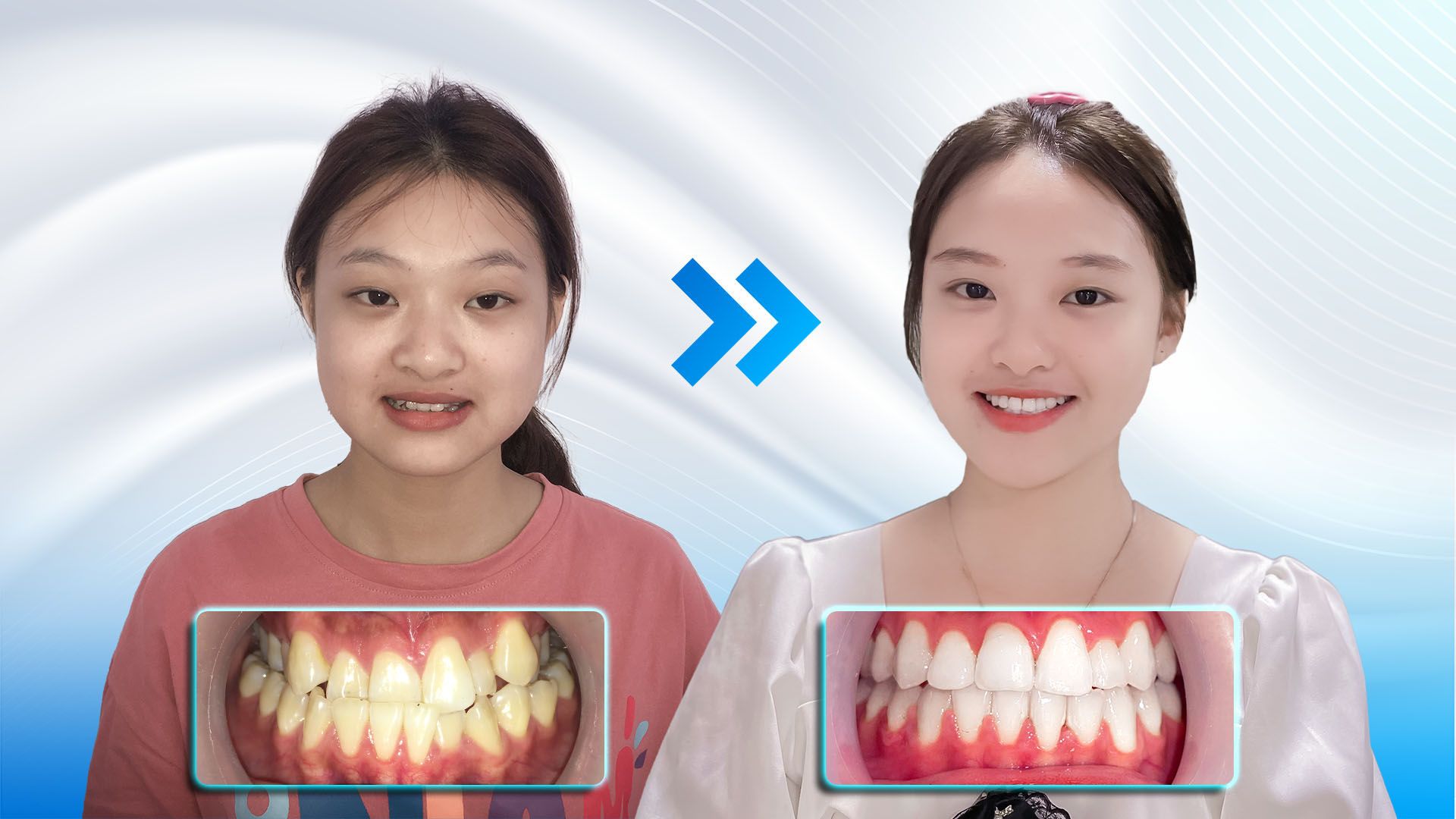 Niềng răng có thay đổi khuôn mặt không?