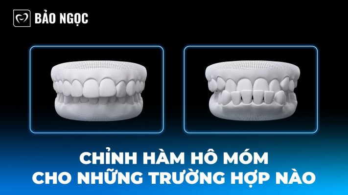 Chỉnh hàm hô móm