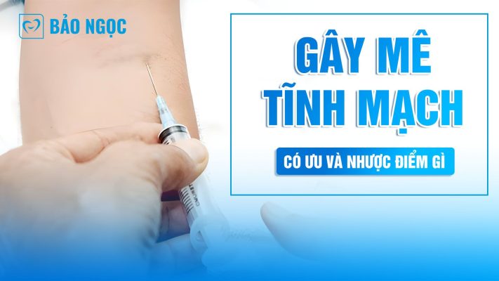 Gây mê tĩnh mạch