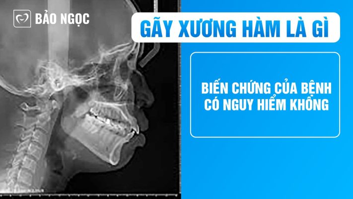 Gãy xương hàm