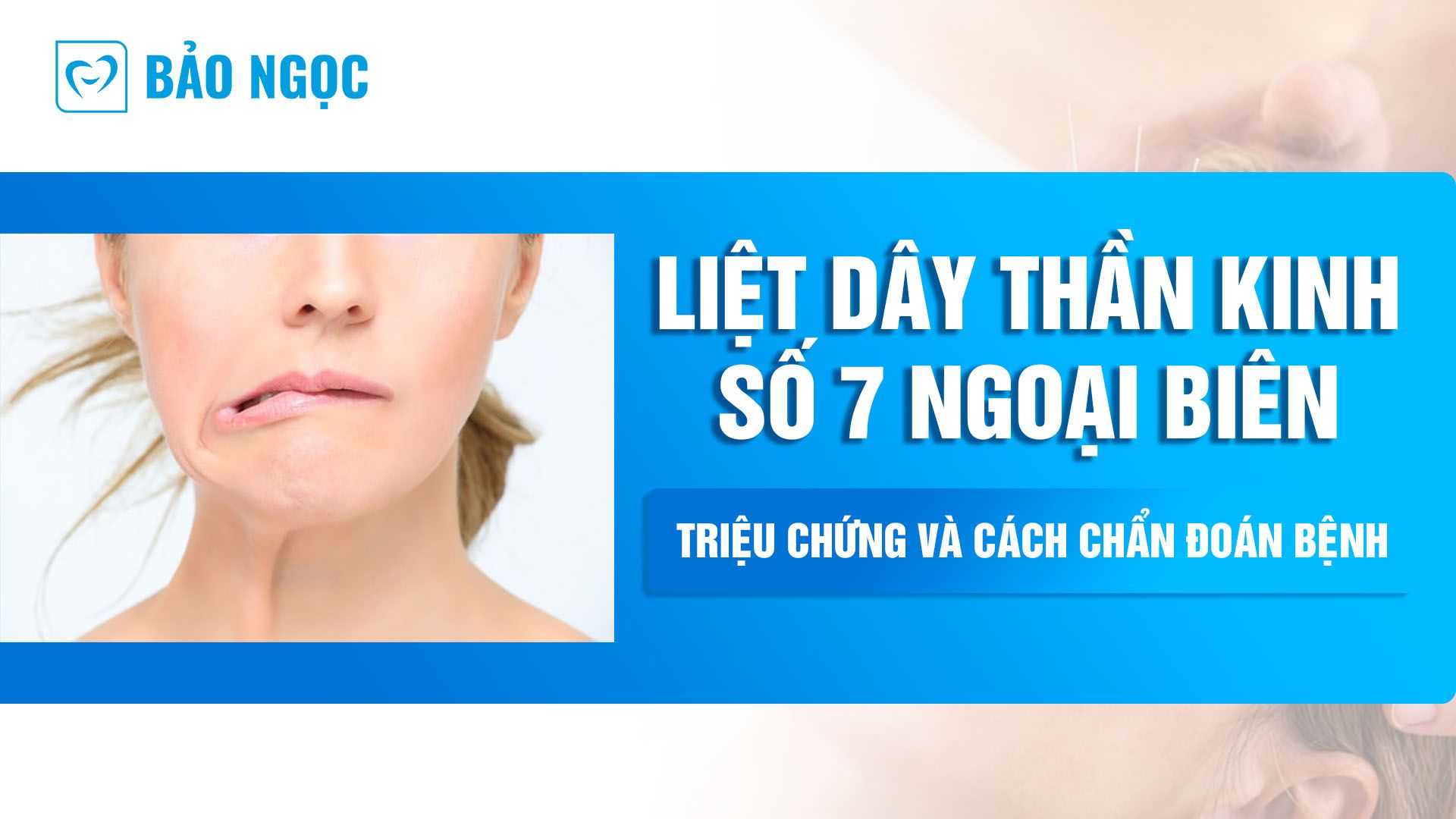 liệt dây thần kinh số 7 ngoại biên