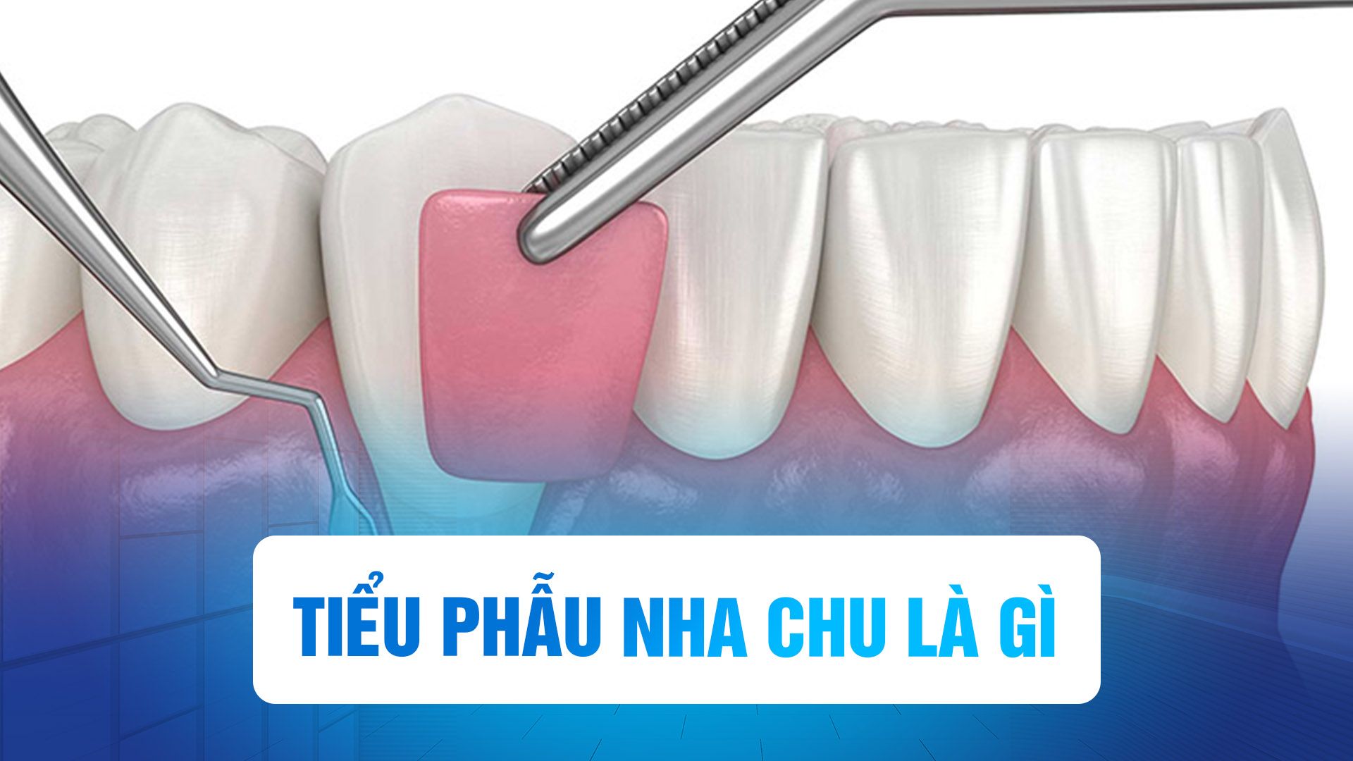 Tiểu phẫu nha chu