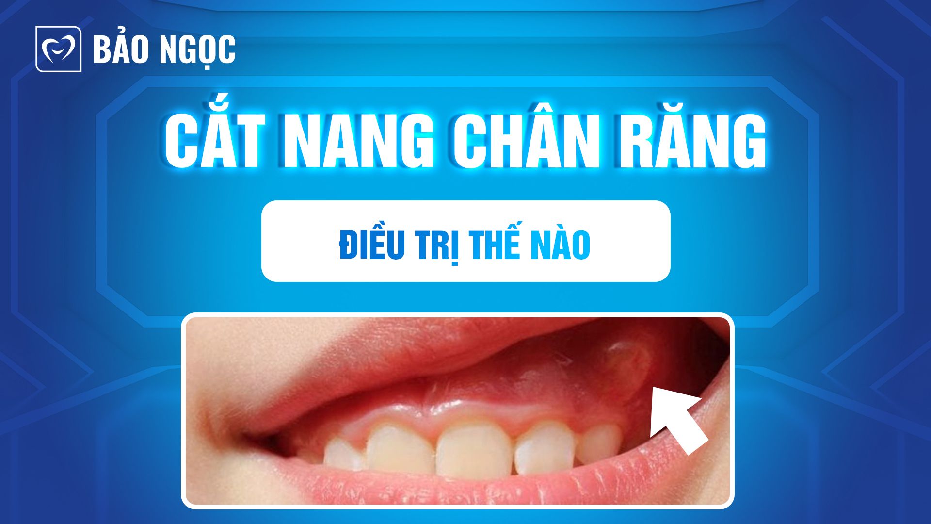 Cắt nang chân răng