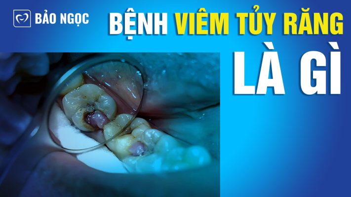 Bệnh viêm tủy răng