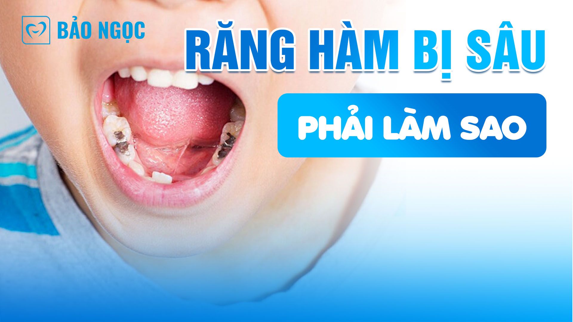 Răng hàm bị sâu