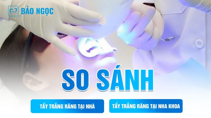 tẩy trắng răng tại nhà và nha khoa