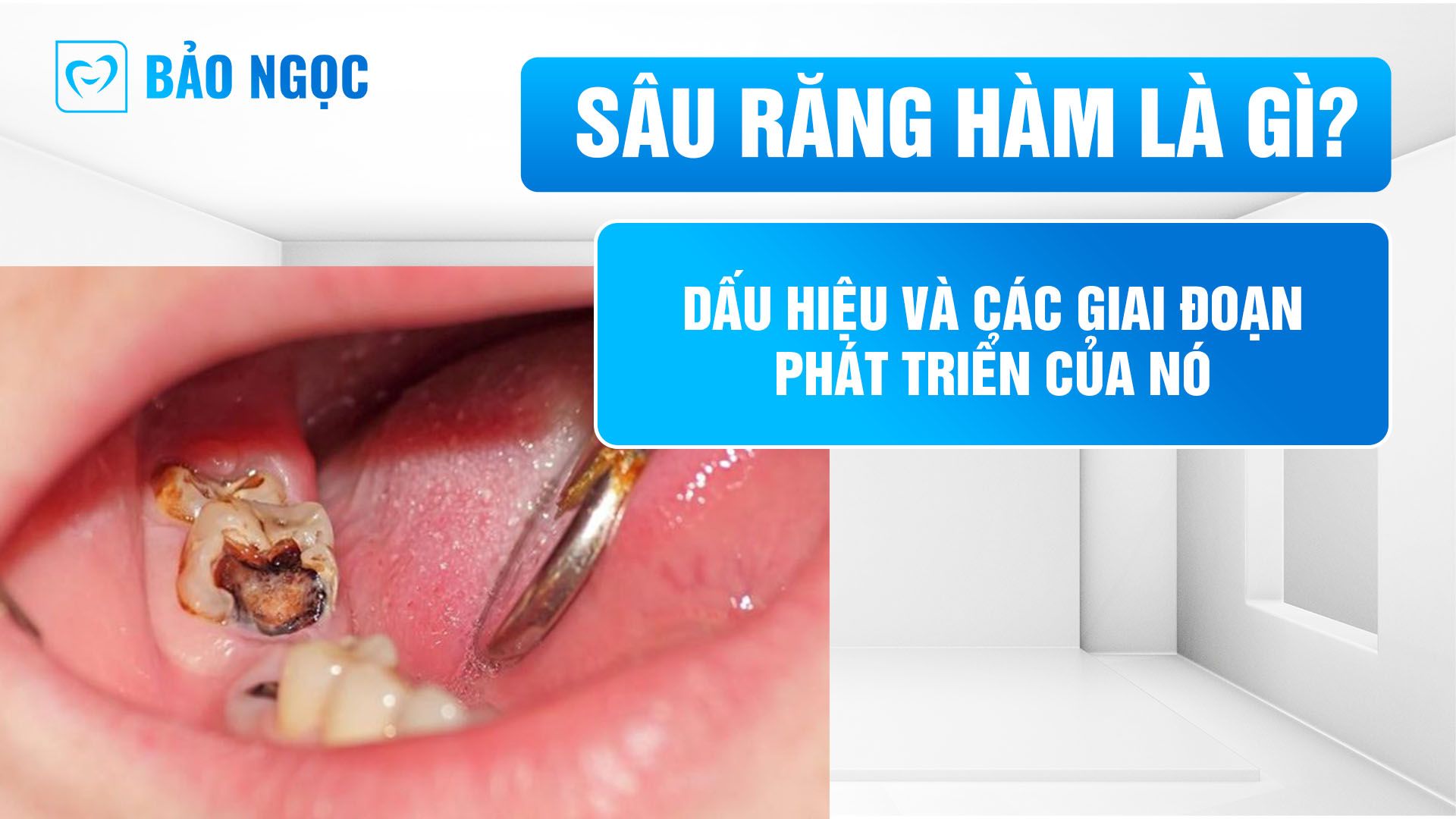 Sâu răng hàm