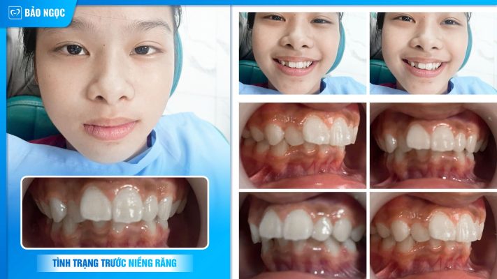 Bệnh nhân nắn chỉnh mới