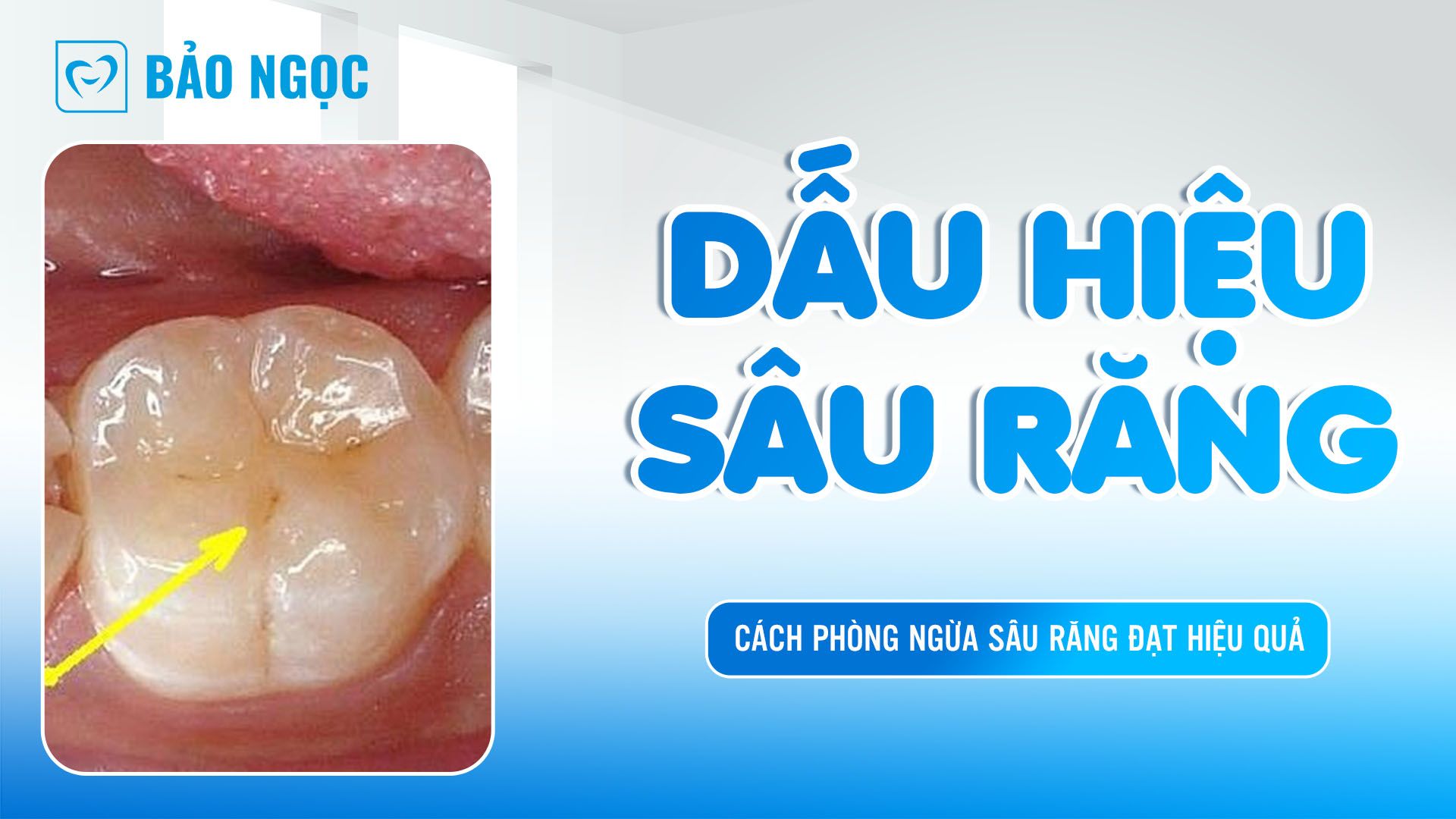 cách phòng ngừa sâu răng