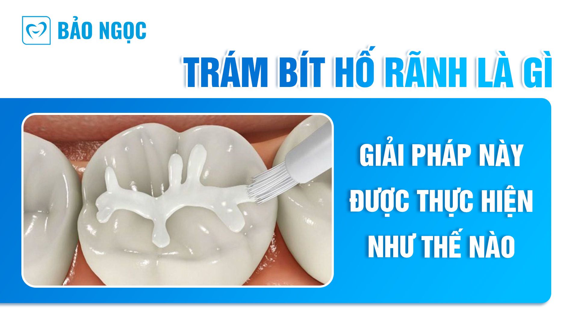Trám bít hố rãnh răng